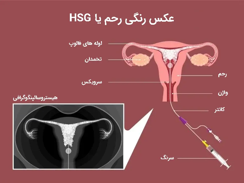 عکس رنگی رحم یا HSG