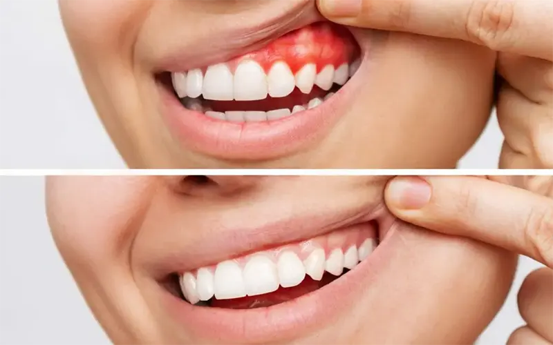 Periodontal treatment درمان پریودنتال