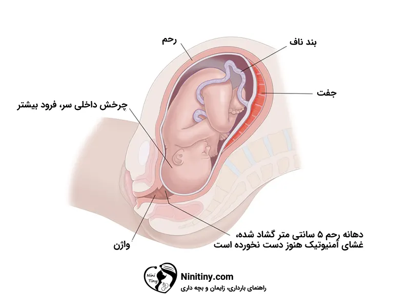 مراحل زایمان طبیعی 1 فاز اکتیو یا فعال از مراحل زایمان طبیعی