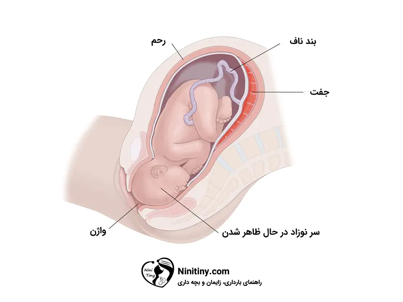مراحل زایمان طبیعی 3 تاج گذاری در روند زایمان