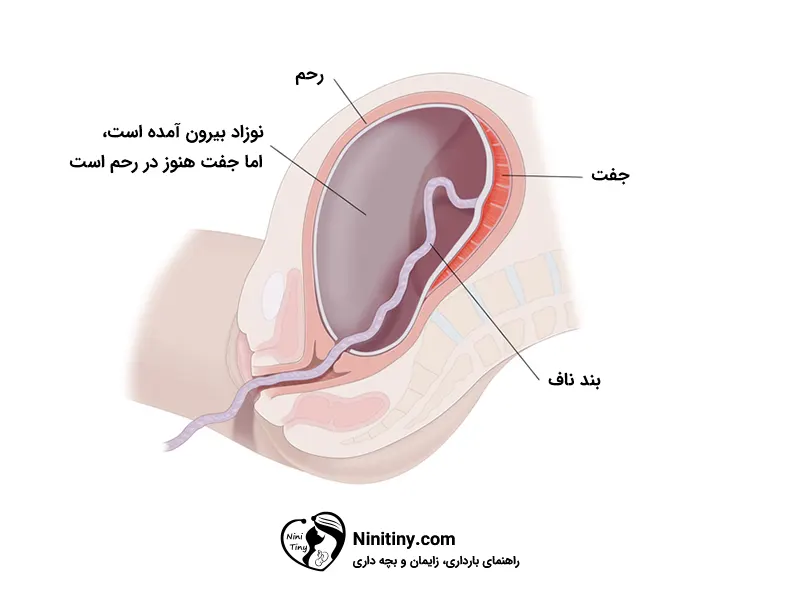 مراحل زایمان طبیعی 6 روند زایمان طبیعی
