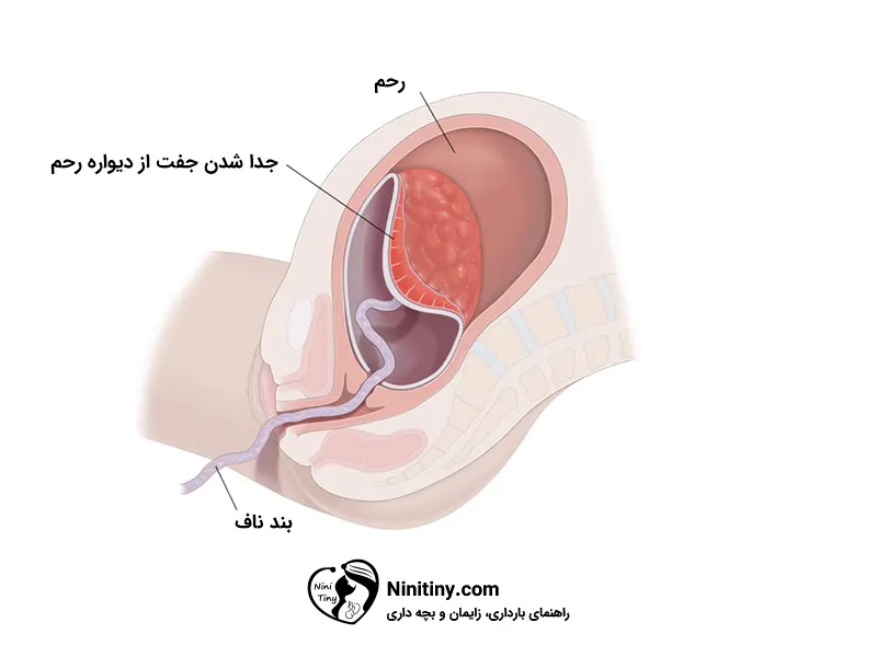 مراحل زایمان طبیعی 7 مرحله سوم زایمان طبیعی