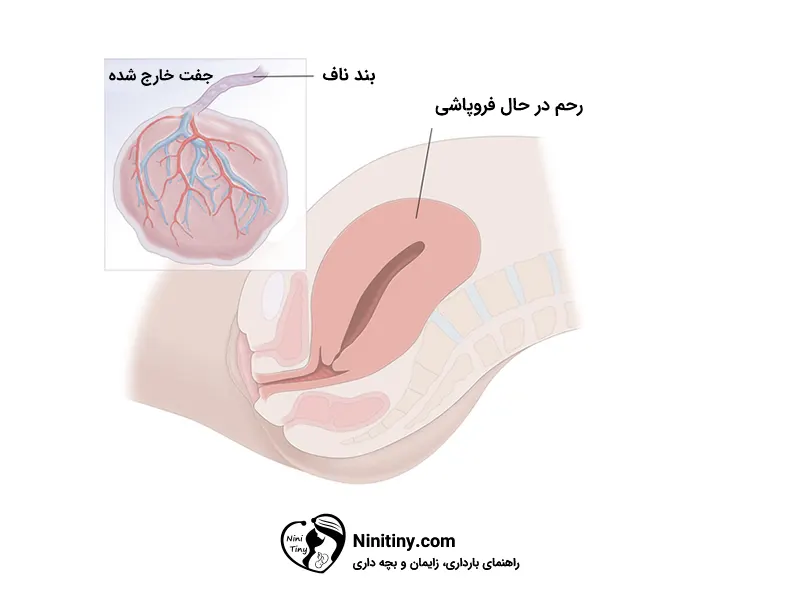 مراحل زایمان طبیعی 8 مرحله سوم زایمان طبیعی