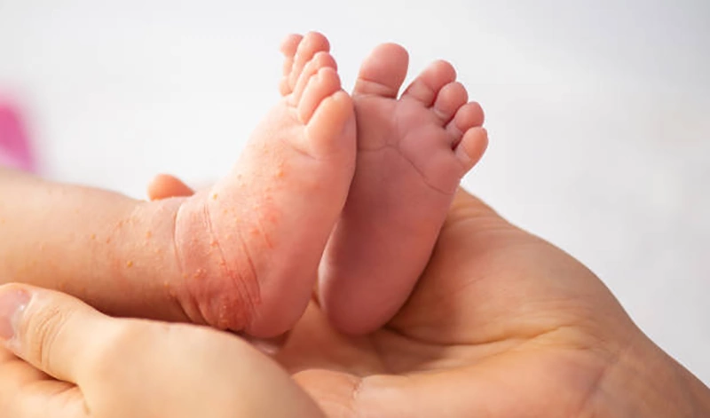 آلرژی به شیر خشک