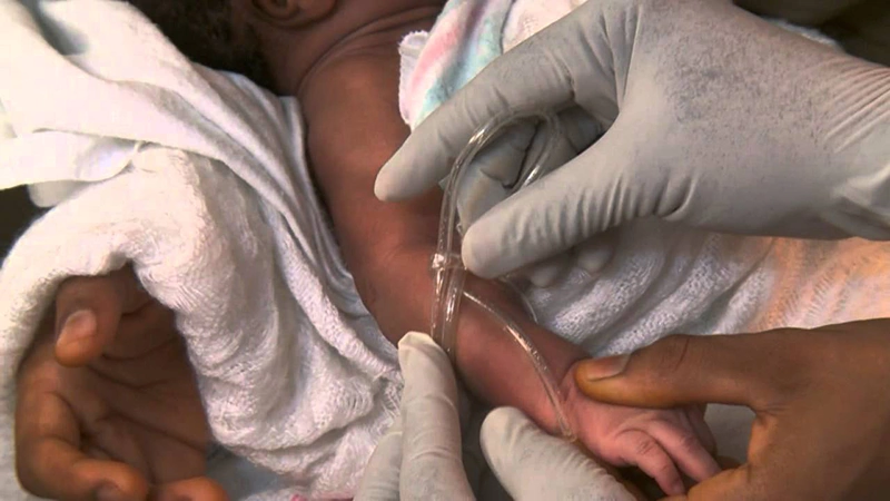 تغذیه نوزاد زودرس در NICU با روش IV تغذیه نوزاد زودرس در NICU با روش IV