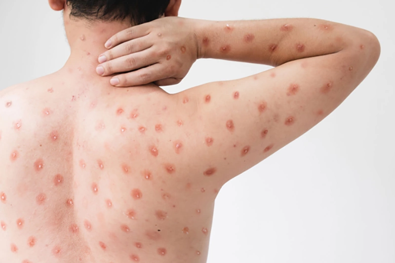 آبله میمونی 2 آبله میمونی در کودکان