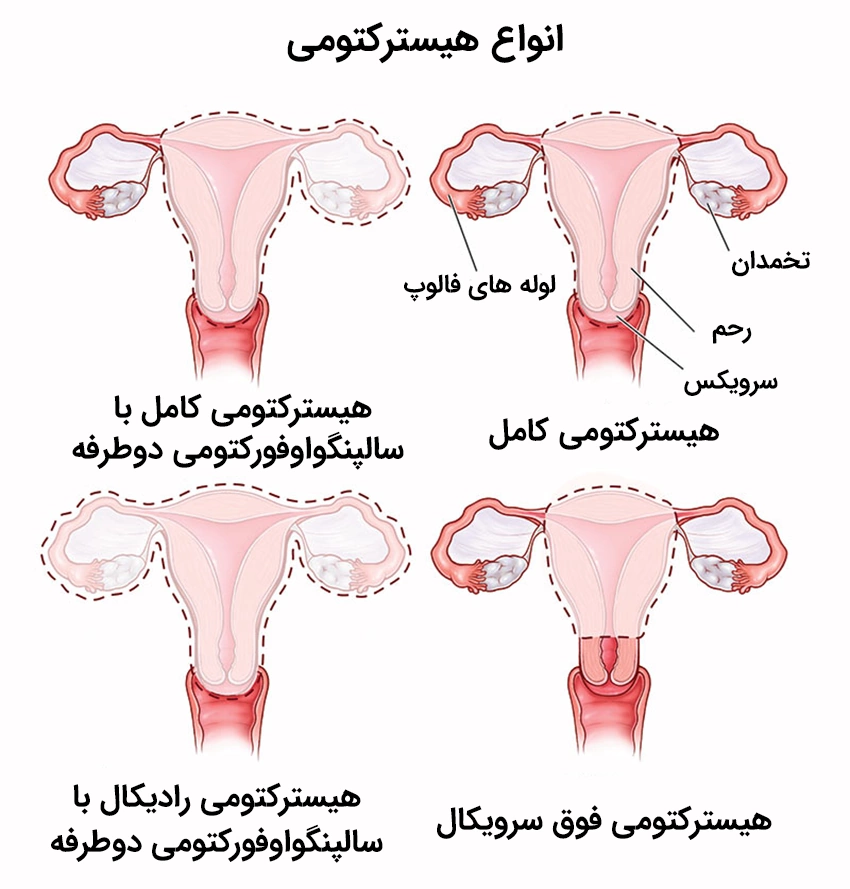 انواع مختلف هیسترکتومی