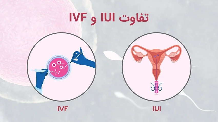تفاوت IUI و IVF تفاوت IUI و IVF
