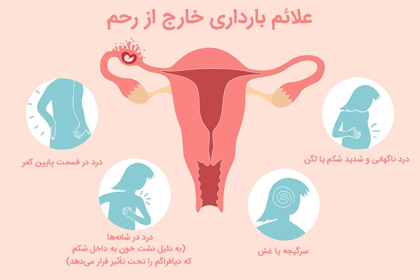 علائم بارداری خارج از رحم علائم و نشانه های بارداری خارج از رحم