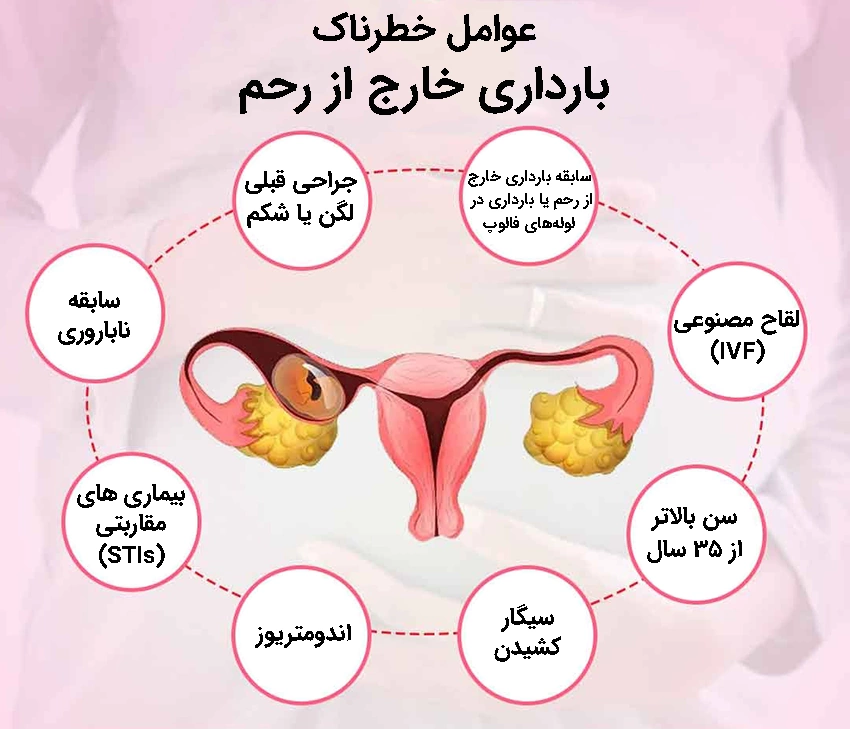 عوامل خطرناک بارداری خارج از رحم عوامل خطرناک بارداری خارج از رحم