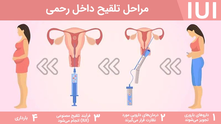 مراحل IUI مراحل IUI