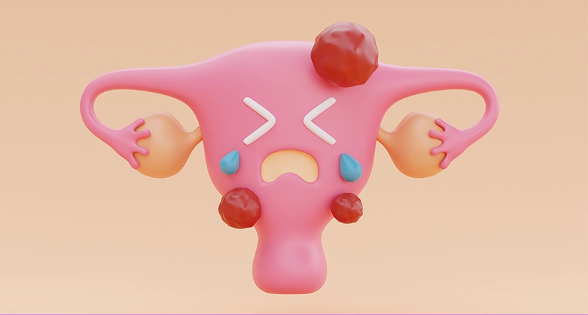 Are uterine fibroids cancerous آیا فیبروم های رحمی سرطانی هستند؟