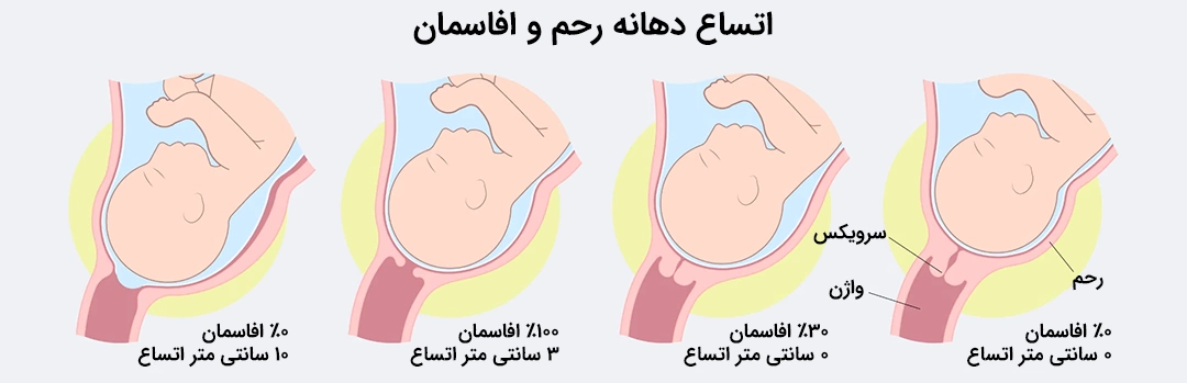 Cervical dilation and effacement stage اتساع دهانه رحم و افاسمان