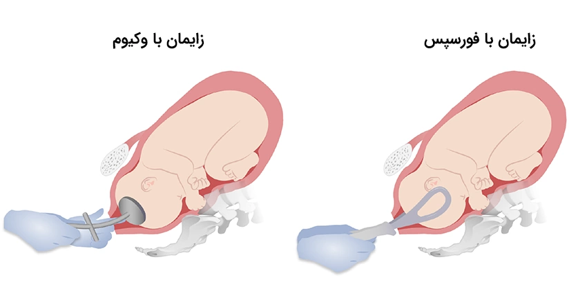 Forceps Vacuum deliveries زایمان با فورسپس یا وکیوم