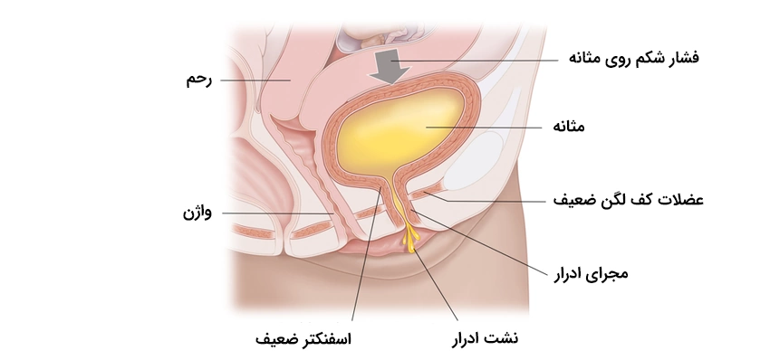 Urinary incontinence during pregnancy 1 روند نشت ادرار در بارداری