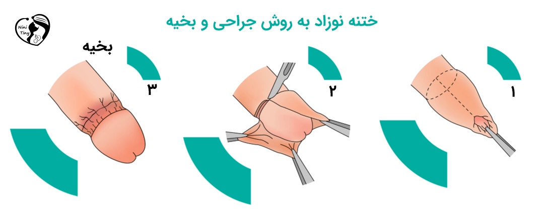 Cut Stitch ختنه به روش بخیه