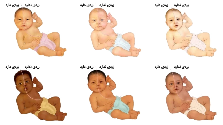Jaundice detection in different skin colors تشخیص زردی نوزاد در رنگ پوست های مختلف