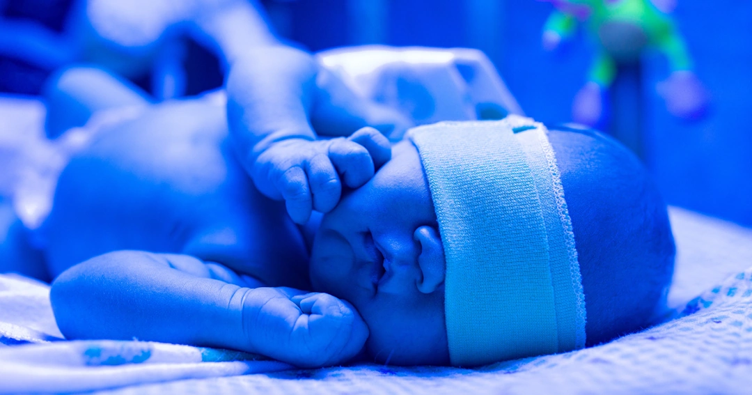 Jaundice treatment درمان زردی نوزاد