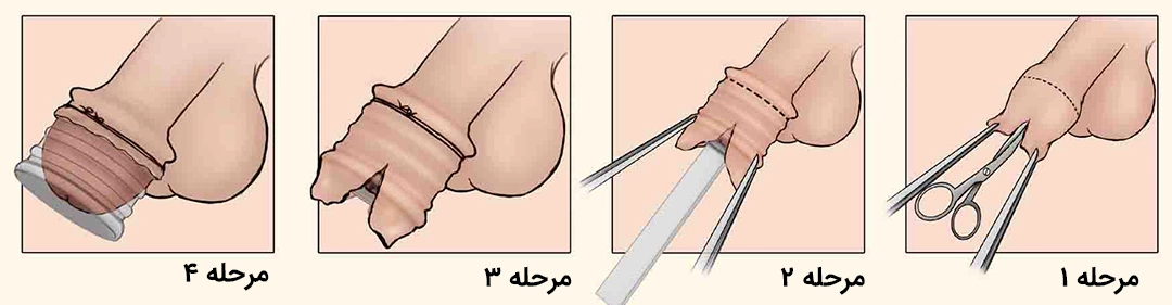 Plastibell Circumplast ختنه به روش حلقه