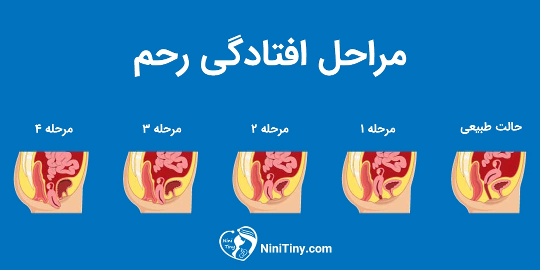 مراحل افتادگی رحم 
