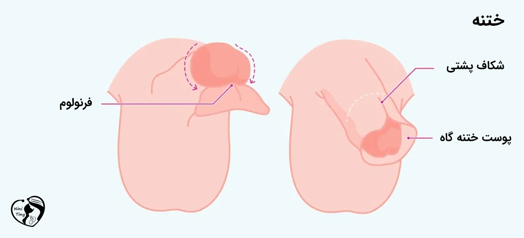 circumcision ختنه نوزاد چیست و چرا انجام می شود؟