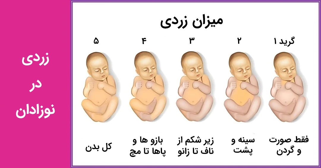 jaundice grade in newborns میزان زردی نوزاد