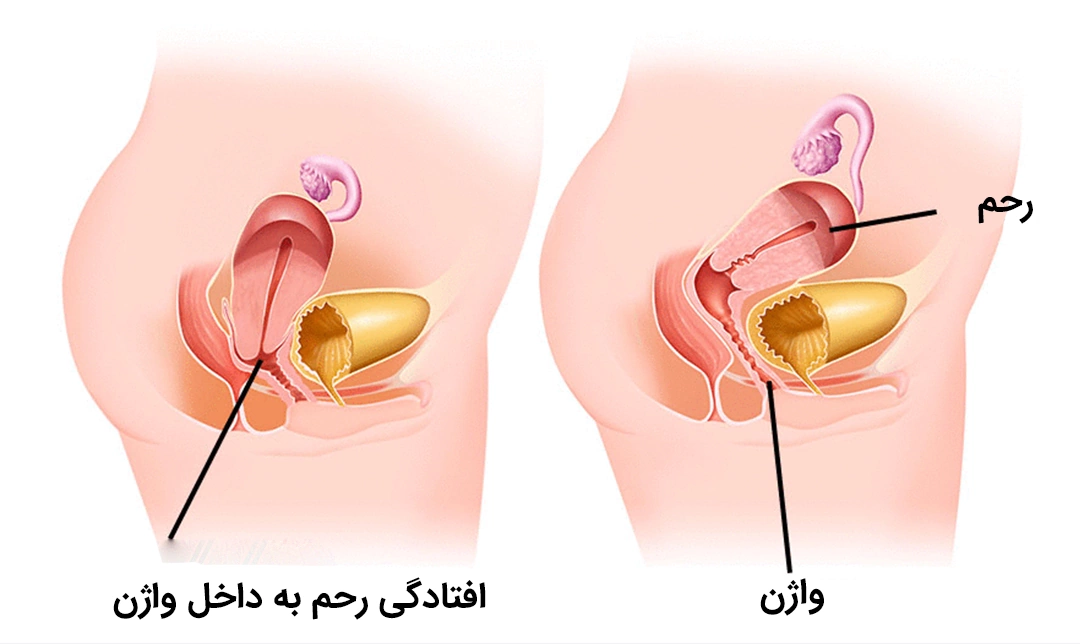 افتادگی رحم چیست؟