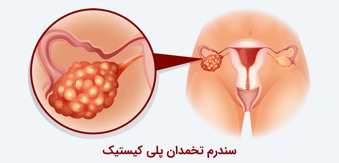 سندرم تخمدان پلی کیستیک چیست؟