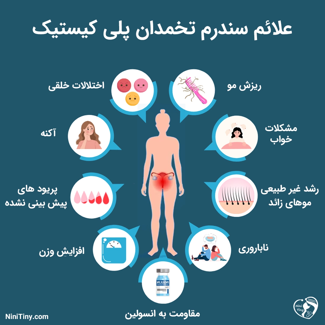 علائم سندرم تخمدان پلی کیستیک