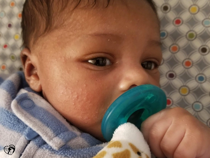 Baby acne جوش های نوزادی