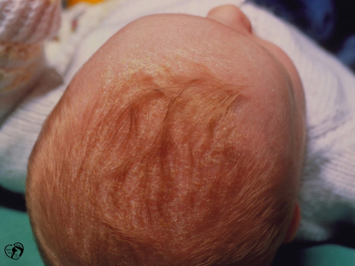 Cradle cap کلاه گهواره ای در کودکان