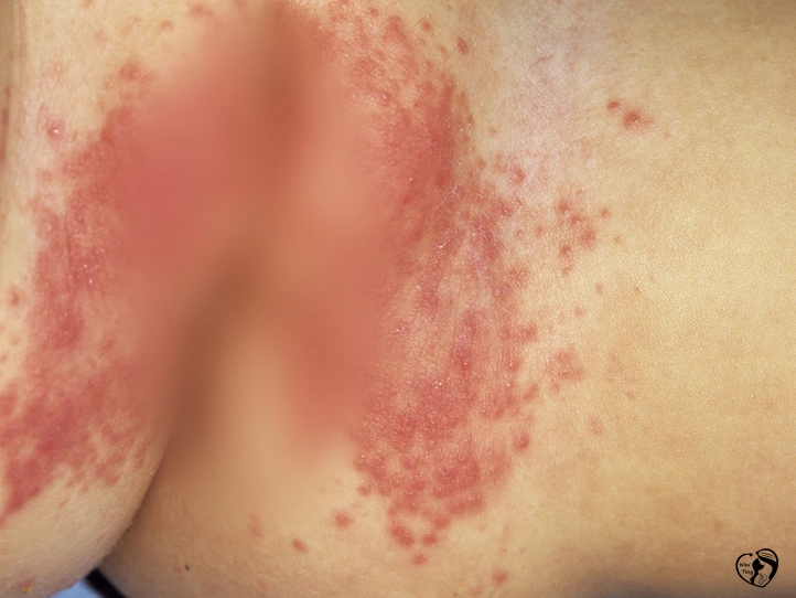 Diaper rash yeast سوختگی پوشک قارچی در کودکان