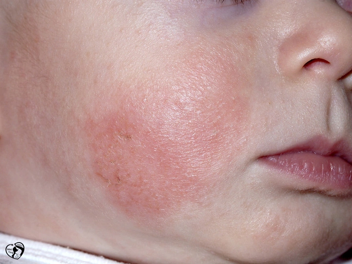Eczema اگزما در کودکان