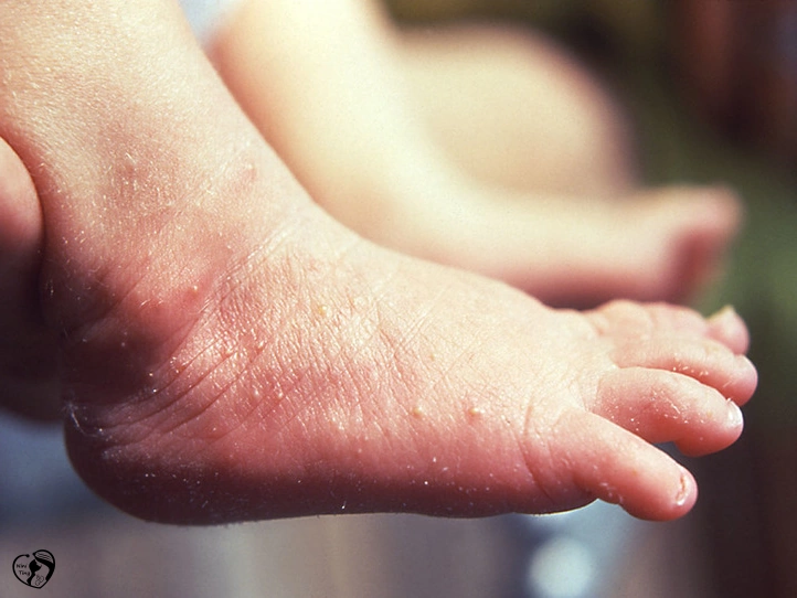 Erythema اریتم توکسیکوم در کودکان