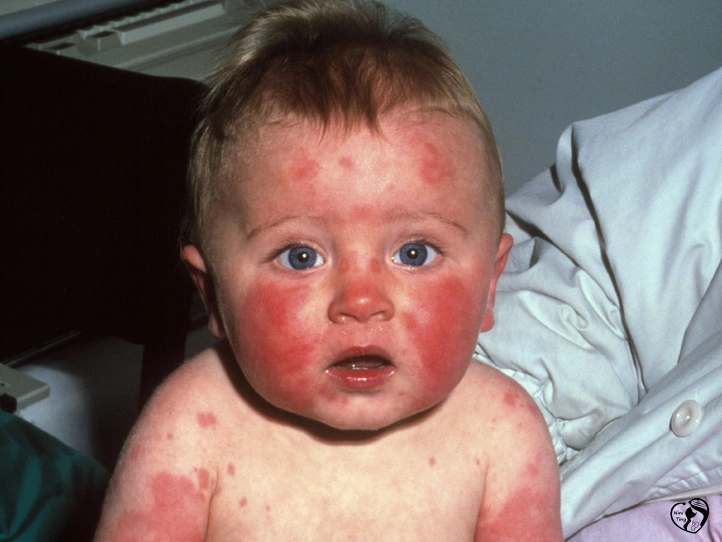 Fifth disease بیماری پنجم در کودکان
