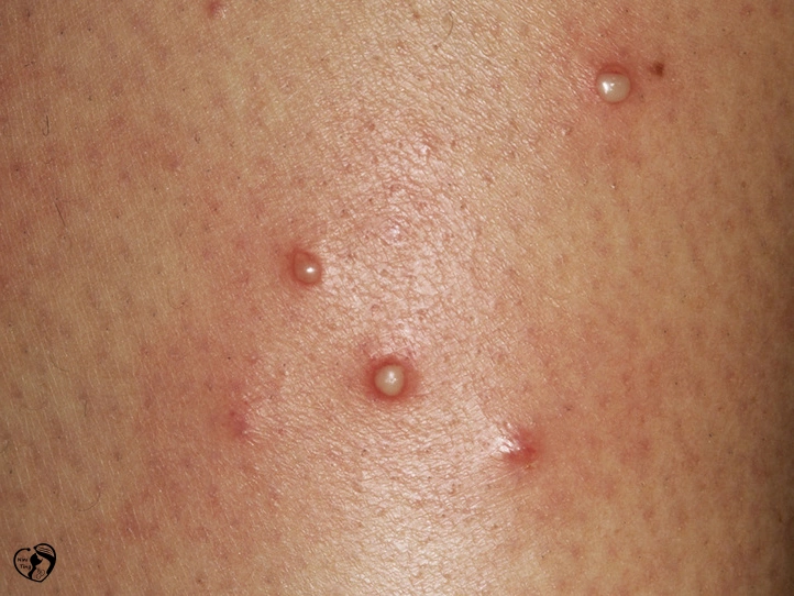 Folliculitis فولیکولیت در کودکان