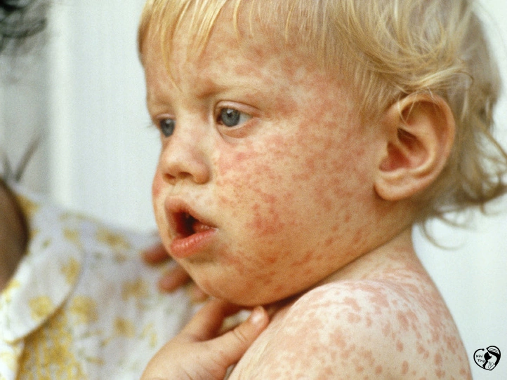 Measles سرخک در کودکان