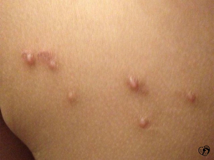 Molloscum contagiosum مولوسکوم در کودکان