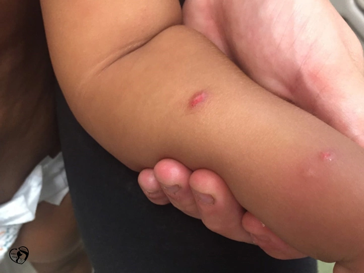 Papular urticaria کهیر پاپولار در کودکان