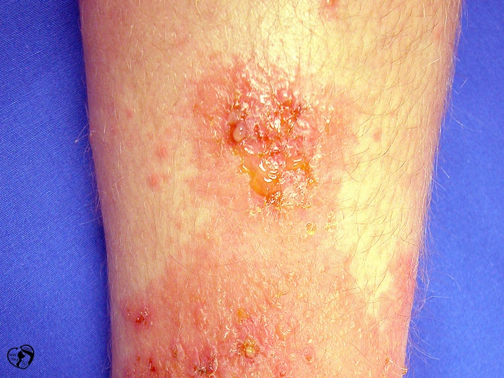 Poison ivy oak or sumac بلوط سمی، پیچک سمی و سماق سمی در کودکان