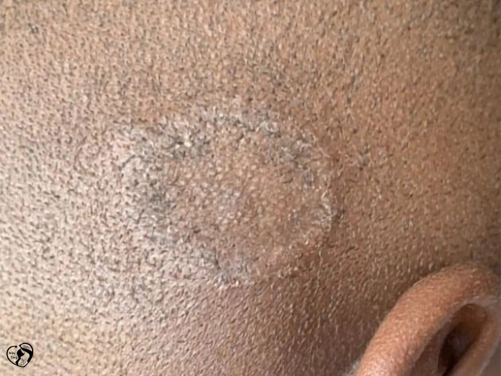Ringworm قارچ حلقوی در کودکان