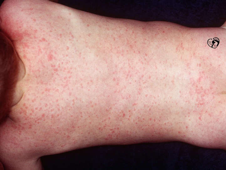 Roseola روزئولا در کودکان