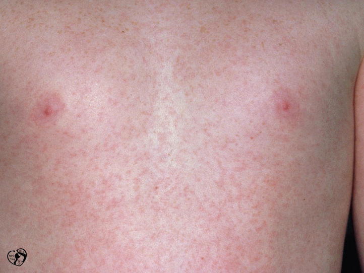 Rubella سرخجه در کودکان