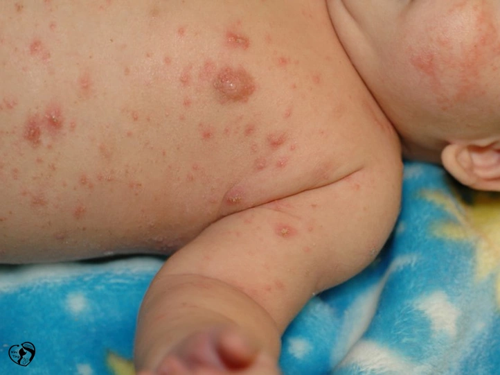 Scabies گال در کودکان