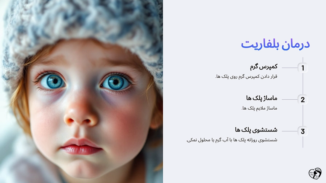 Treatment of blepharitis in children درمان بلفاریت در کودکان