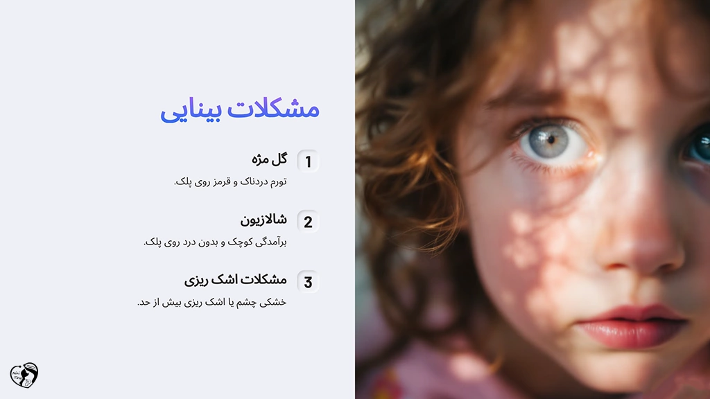 Vision problems due to blepharitis in children مشکلات بینایی در پی ابتلا به بلفاریت در کودکان
