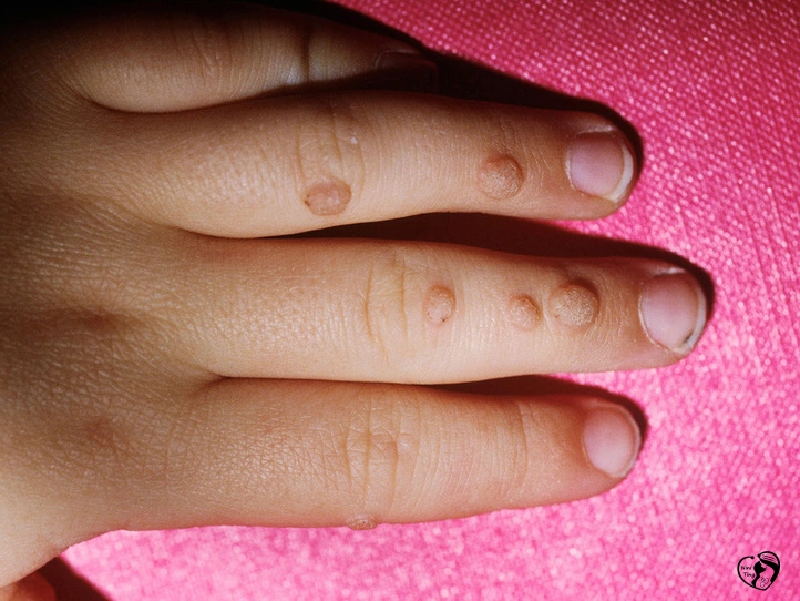 Warts زگیل در کودکان