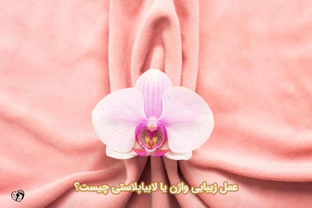 لابیاپلاستی لابیاپلاستی