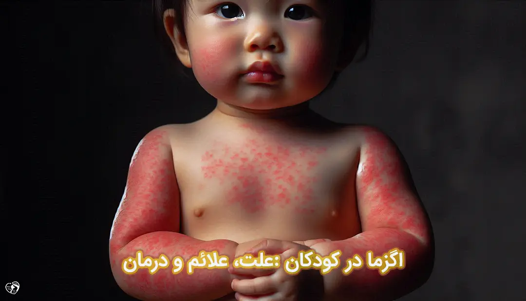 اگزما در کودکان اگزما در کودکان