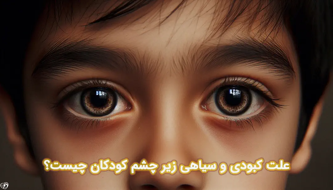 سیاهی زیر چشم در کودکان سیاهی زیر چشم در کودکان